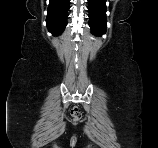 Acute appendicitis, heterotaxy syndrome (Radiopaedia 66884-76202 Coronal C+ portal venous phase 108).jpg