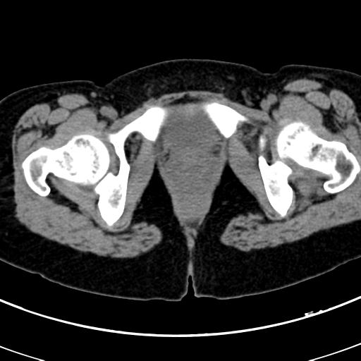 Acute appendicitis (Radiopaedia 30261-30888 Axial non-contrast 112).jpg
