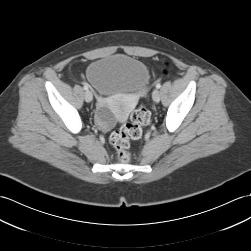 Acute appendicitis (Radiopaedia 30297-30934 Axial C+ portal venous phase 69).jpg