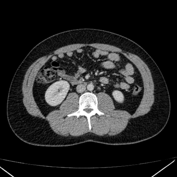 Acute appendicitis (Radiopaedia 38255-40270 Axial C+ portal venous phase 52).jpg