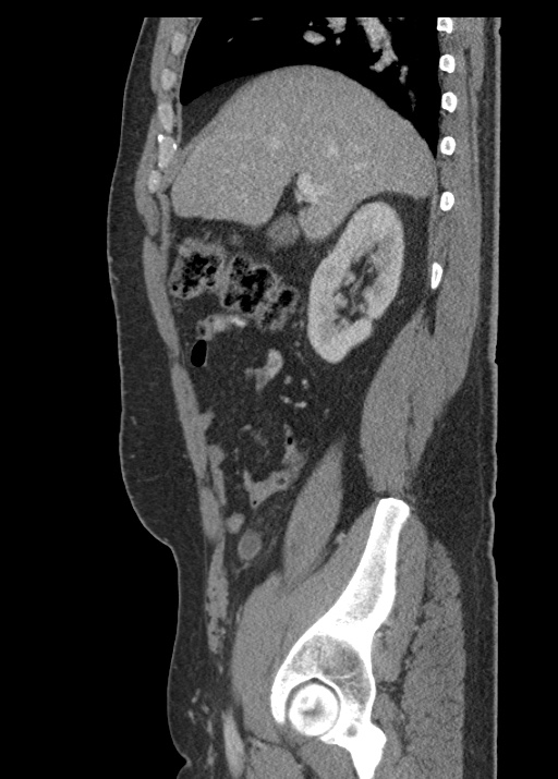 Acute appendicitis (Radiopaedia 48511-53463 Sagittal C+ portal venous phase 49).jpg