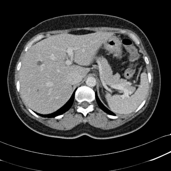 File:Acute appendicitis (Radiopaedia 48792-53822 Axial C+ portal venous phase 24).jpg
