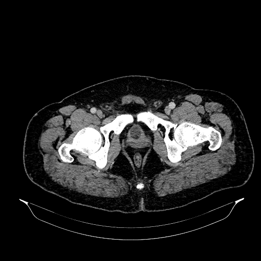 File:Acute appendicitis (Radiopaedia 79950-93224 Axial C+ portal venous phase 99).jpg