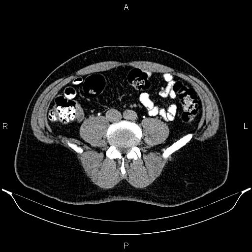 Acute appendicitis (Radiopaedia 84780-100240 Axial C+ delayed 67).jpg
