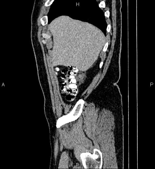 Acute appendicitis (Radiopaedia 84780-100240 Sagittal C+ portal venous phase 11).jpg