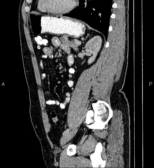 Acute appendicitis (Radiopaedia 84780-100240 Sagittal C+ portal venous phase 70).jpg