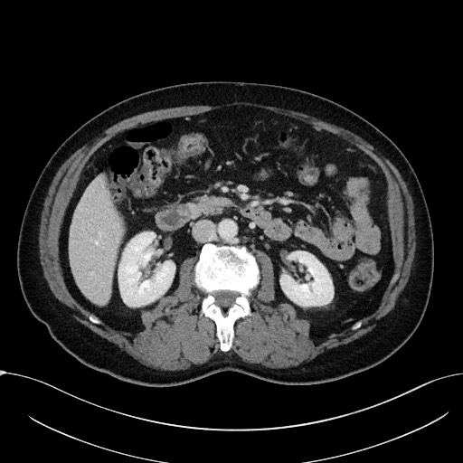 Acute appendicitis - large appendicoliths (Radiopaedia 61805-69820 Axial C+ portal venous phase 55).jpg