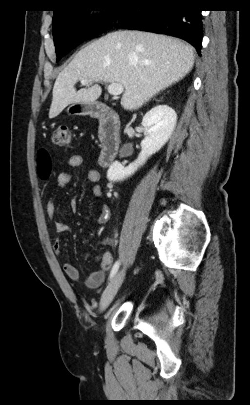 Acute appendicitis - large appendicoliths (Radiopaedia 61805-69820 Sagittal C+ portal venous phase 75).jpg