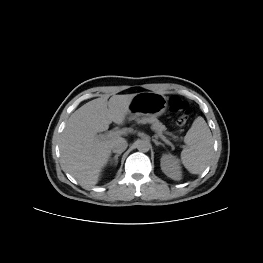 Acute appendicitis and COVID 19 pneumonia (Radiopaedia 76604-88380 Axial non-contrast 58).jpg