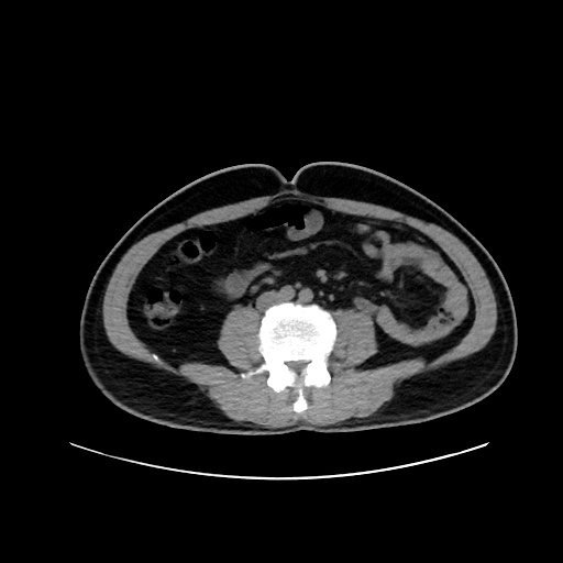 Acute appendicitis and COVID 19 pneumonia (Radiopaedia 76604-88380 Axial non-contrast 84).jpg