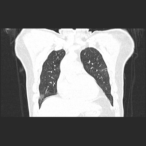 Acute appendicitis and COVID 19 pneumonia (Radiopaedia 76604-88380 G 21).jpg