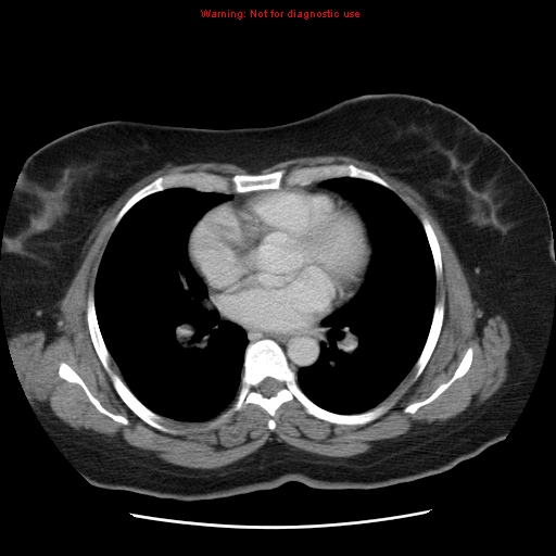 Acute appendicitis complicated by ovarian vein thrombophlebitis (Radiopaedia 16172-15851 Axial C+ portal venous phase 3).jpg