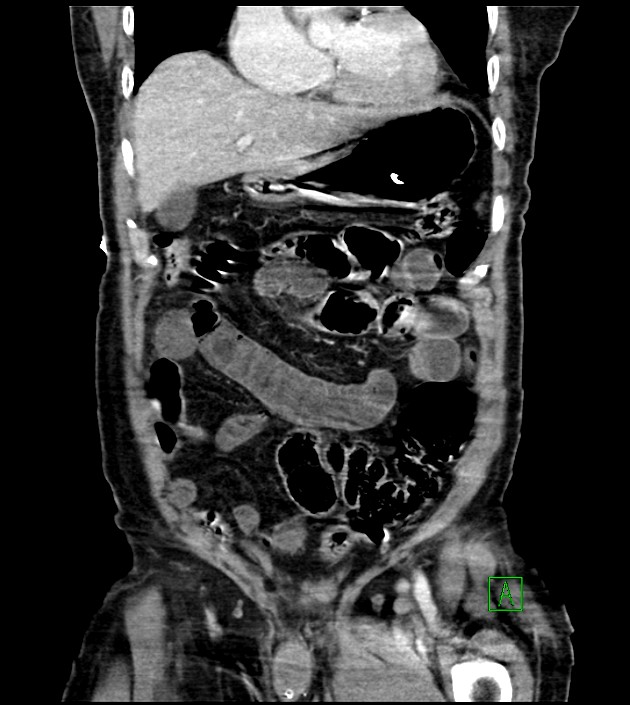 Acute arterial mesenteric ischemia (Radiopaedia 78238-90828 Coronal C+ portal venous phase 34).jpg