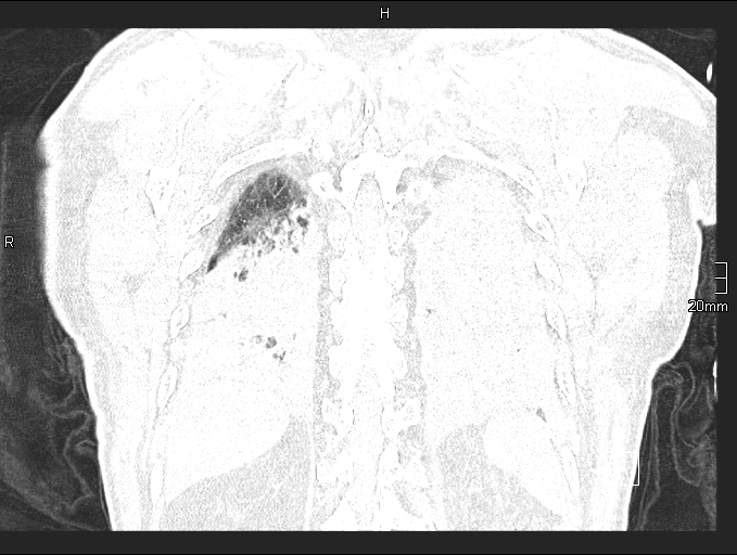 File:Acute aspiration pneumonitis (Radiopaedia 55642-62166 Coronal lung window 88).jpg