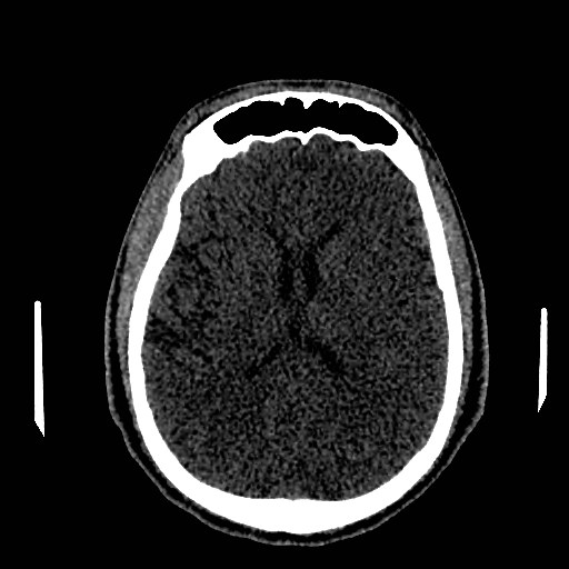 Acute basilar artery occlusion (Radiopaedia 43582-46985 Axial non-contrast 105).jpg