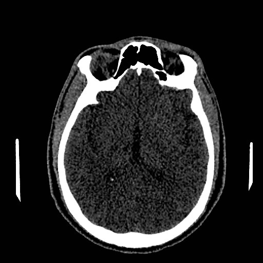 Acute basilar artery occlusion (Radiopaedia 43582-46985 Axial non-contrast 95).jpg