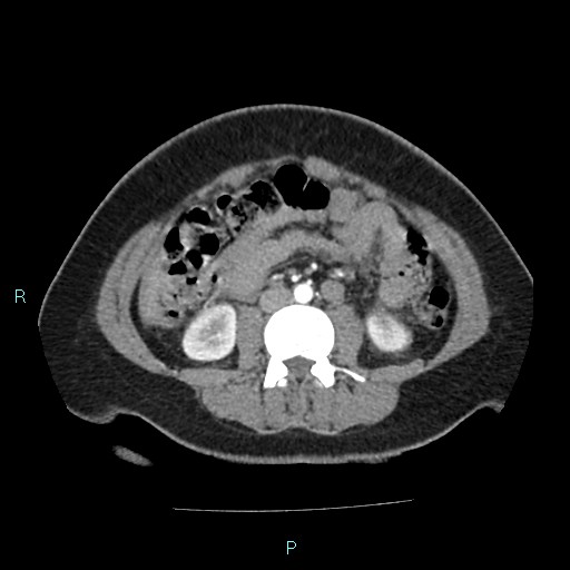 Acute bilateral pyelonephritis (Radiopaedia 37146-38881 Axial C+ arterial phase 104).jpg