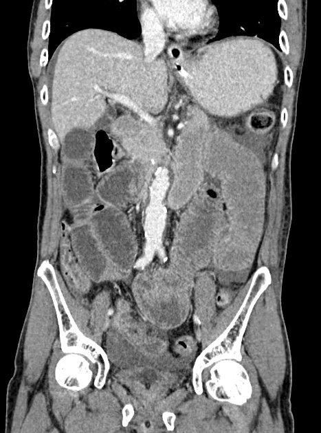 Acute bowel ischemia (Radiopaedia 87695-104114 Coronal C+ portal venous phase 195).jpg
