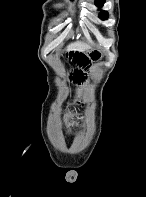 Acute bowel ischemia (Radiopaedia 87695-104114 Coronal C+ portal venous phase 77).jpg