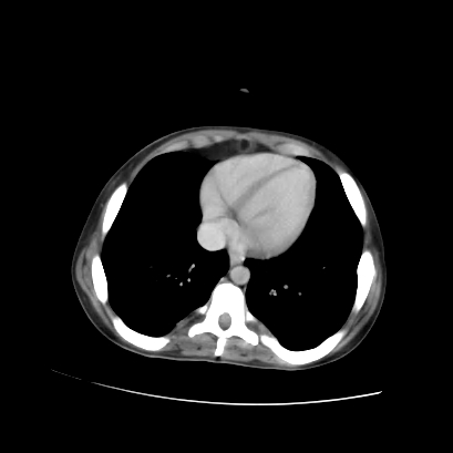 Acute calculous cholecystitis in patient with osteopetrosis (Radiopaedia 77871-90159 Axial C+ portal venous phase 13).jpg