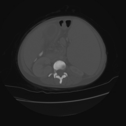 File:Acute calculous cholecystitis in patient with osteopetrosis (Radiopaedia 77871-90159 Axial bone window 24).jpg