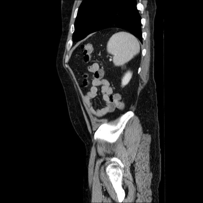 Acute cholecystitis and incidental left sided IVC (Radiopaedia 49352-54459 Sagittal C+ portal venous phase 22).jpg