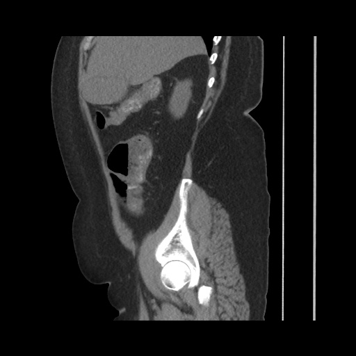 Acute cholecystitis with tensile fundus sign (Radiopaedia 71394-81723 Sagittal non-contrast 55).jpg