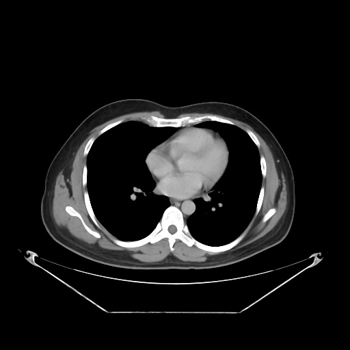 File:Acute complicated calculous cholecystitis (Radiopaedia 55202-61587 Axial C+ delayed 9).jpg