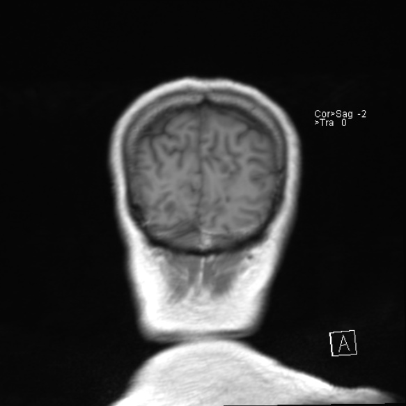 File:Acute disseminated encephalomyelitis (Radiopaedia 37253-39033 Coronal T1 23).jpg