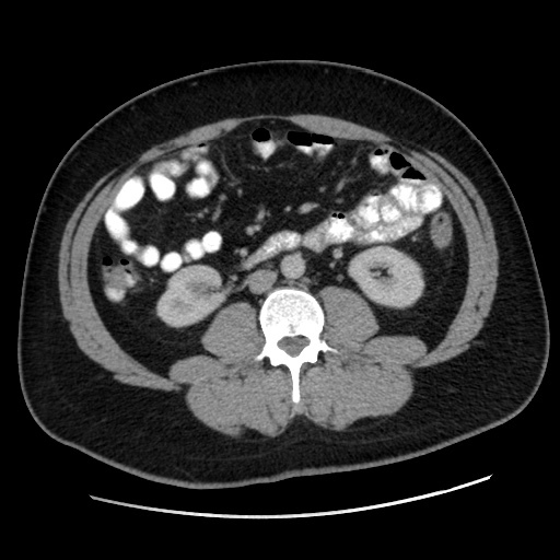 Acute diverticulitis with localized perforation (Radiopaedia 41296-44113 Axial C+ portal venous phase 47).jpg
