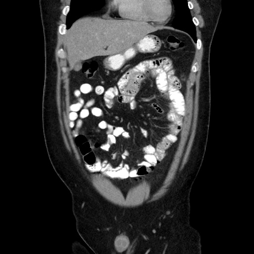 Acute diverticulitis with localized perforation (Radiopaedia 41296-44113 Coronal C+ portal venous phase 21).jpg