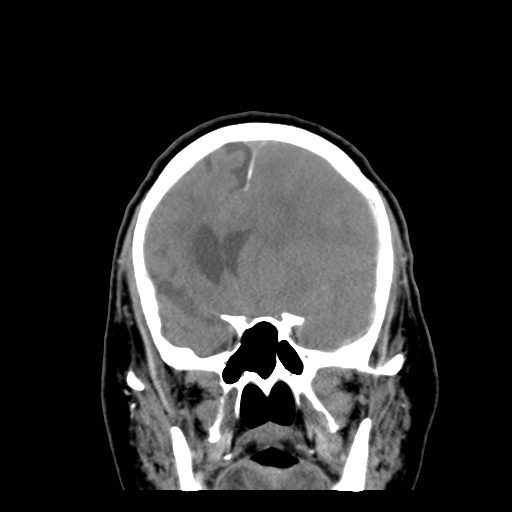 Acute hemorrhagic stroke (Radiopaedia 17507-17223 Coronal non-contrast 18).jpg