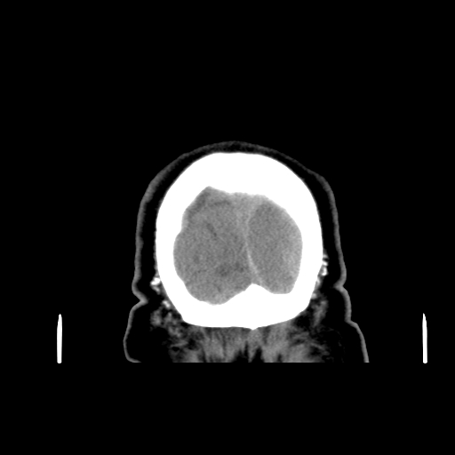 Acute hemorrhagic stroke (Radiopaedia 17507-17223 Coronal non-contrast 55).jpg