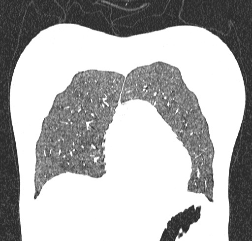 Acute hypersensitivity pneumonitis (Radiopaedia 85293-100870 Coronal lung window 19).jpg