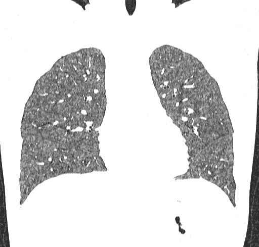 Acute hypersensitivity pneumonitis (Radiopaedia 85293-100870 Coronal lung window 47).jpg