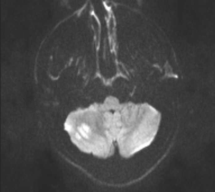 Acute ischemic stroke - posterior circulation territory (Radiopaedia 77670-89880 Axial DWI 28).jpg