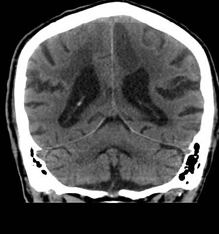 File:Acute left anterior cerebral artery territory infarction (Radiopaedia 51785-57578 Coronal non-contrast 41).jpg