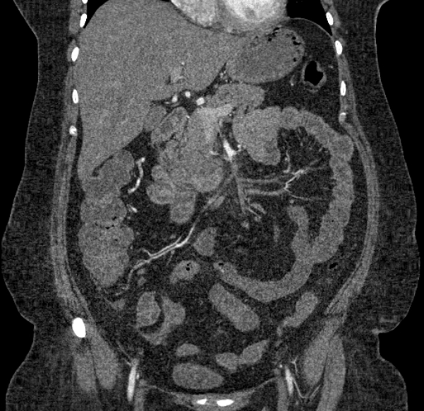 Acute mesenteric ischemia (Radiopaedia 80029-93316 Coronal C+ arterial phase 57).jpg