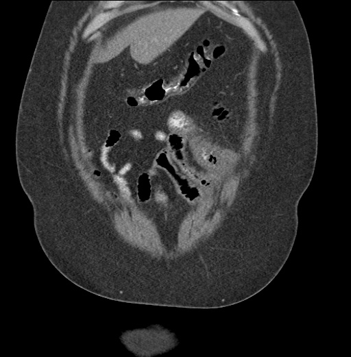 Acute mesenteric venous ischemia (Radiopaedia 46041-50383 Coronal C+ portal venous phase 17).jpg