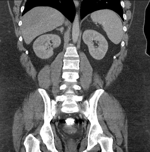 Acute mesenteric venous ischemia (Radiopaedia 46041-50383 Coronal C+ portal venous phase 64).jpg