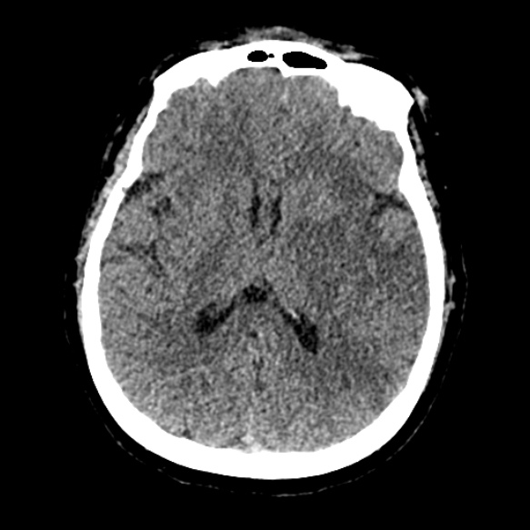 Acute middle cerebral artery territory infarct (Radiopaedia 52380-58283 Axial non-contrast 56).jpg