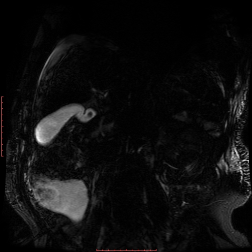 File:Acute necrotizing pancreatitis (Radiopaedia 28194-28448 Coronal MRCP 26).jpg