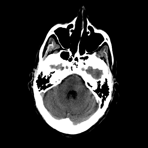 File:Acute necrotizing toxoplasma encephalitis (Radiopaedia 10683-11150 Axial non-contrast 26).jpg