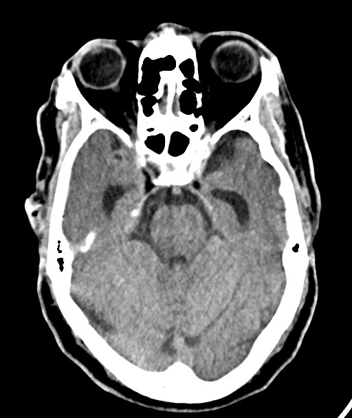 Acute on chronic subdural hematoma (Radiopaedia 78346-90966 Axial non-contrast 24).jpg