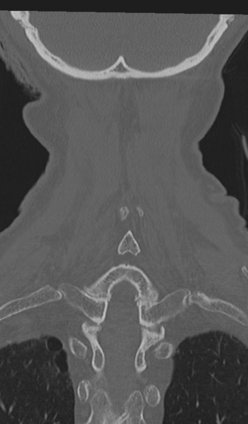Acute on chronic subdural hematoma and thoracic vertebral injury in a multitrauma patient (Radiopaedia 31698-32619 Coronal bone window 55).jpg