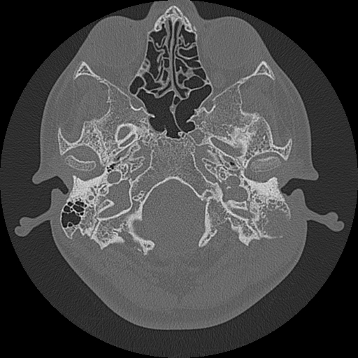 Acute otomastoiditis and Bezold abscess (Radiopaedia 88184-104786 Axial bone window 21).jpg