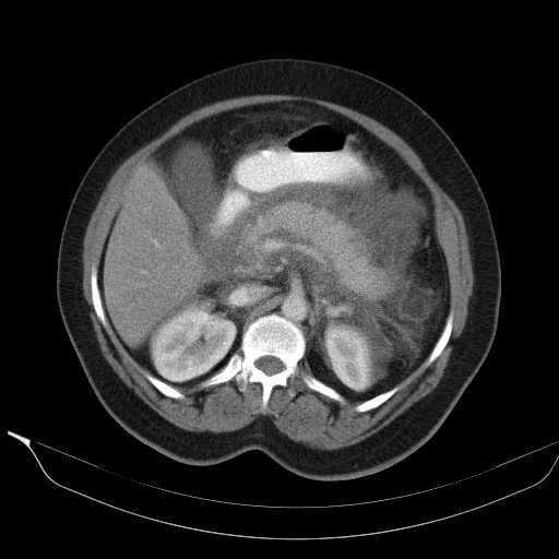 File:Acute pancreatitis (Radiopaedia 20829-20744 Axial C+ portal venous phase 17).jpg
