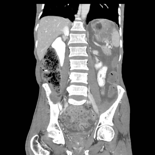 File:Acute pancreatitis (Radiopaedia 50213-55558 Coronal C+ portal venous phase 28).jpg