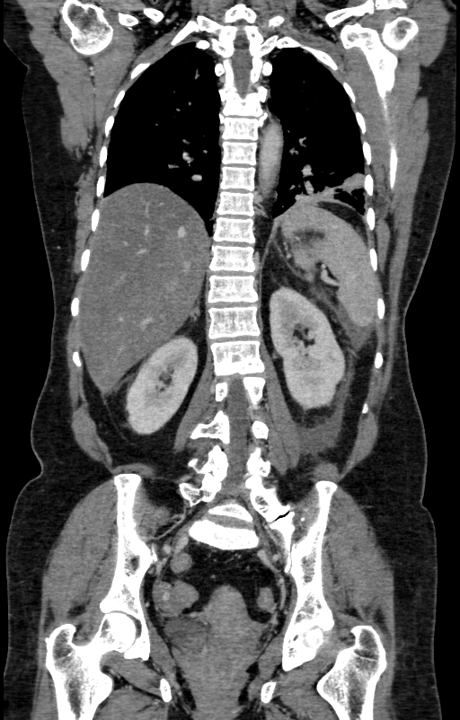 Acute pancreatitis (Radiopaedia 80007-93285 Coronal C+ portal venous phase 110).jpg