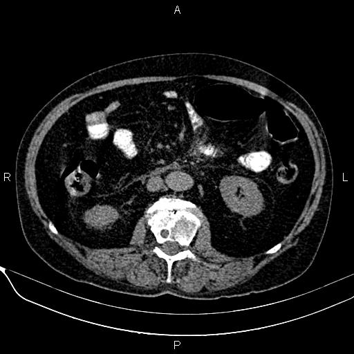 Acute pancreatitis (Radiopaedia 85146-100701 Axial non-contrast 62).jpg